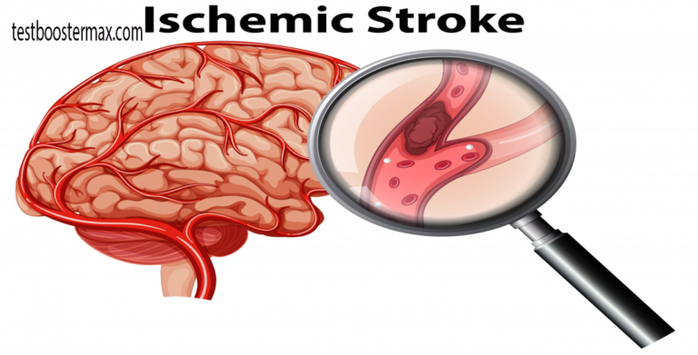 Stroke Iskemik: Pemahaman Mendalam tentang Jenis Stroke