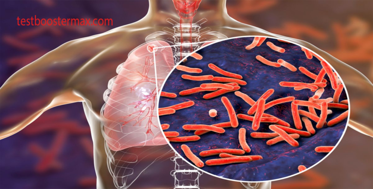 Tuberkulosis: Penyakit Menular yang Masih Merajalela