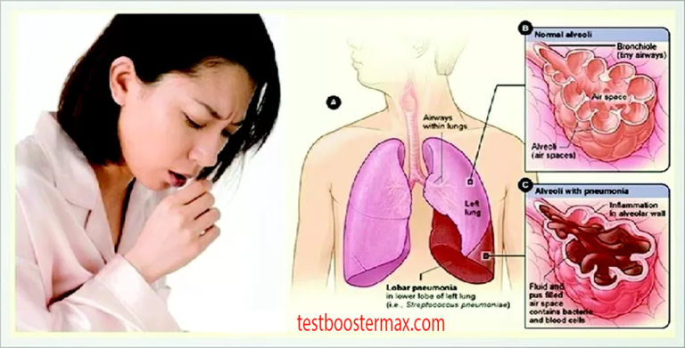 Tuberkulosis Penyakit Menular yang Perlu Diwaspadai