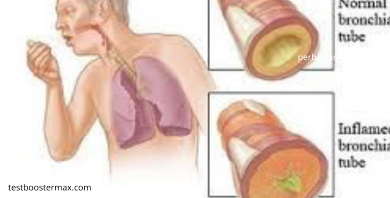 Bronkitis Kronis Musuh Senyap yang Menyerang Paru-paru
