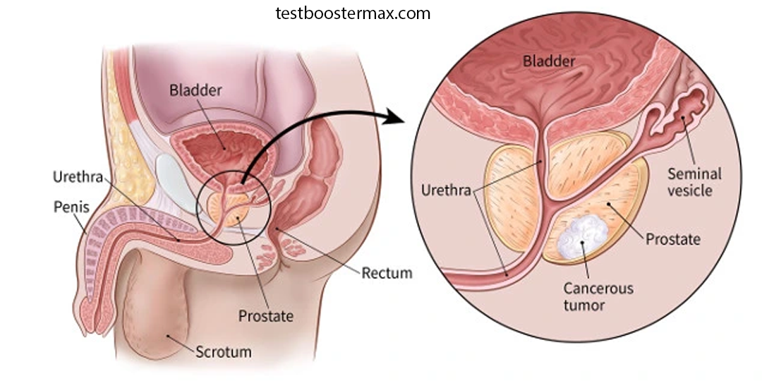 Kanker Prostat Gejala