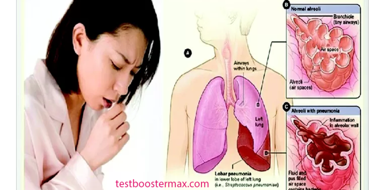 Mengenal Tuberkulosis Ekstraparu: Ancaman Silent