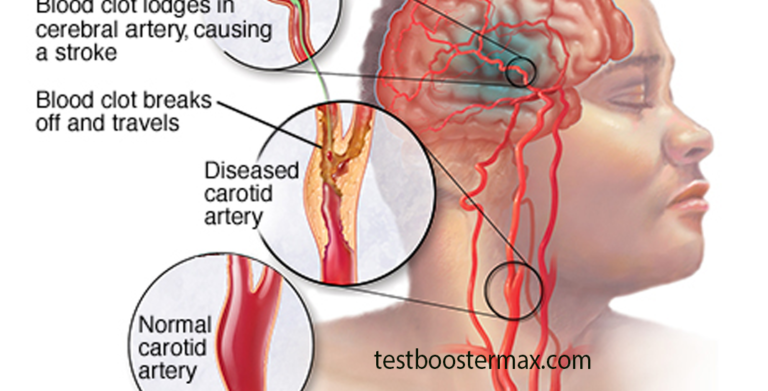 Stroke Menyerang Tanpa Disadari Kenali Gejala Awalnya