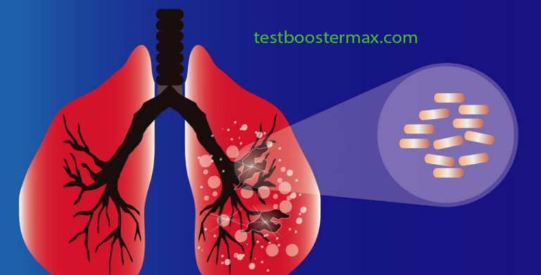 Tuberkulosis Milier Hujan Butiran Kematian di Paru-paru