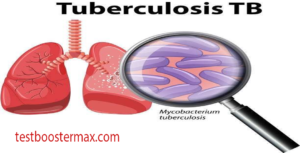 Tuberkulosis Penyakit Menular