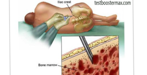 Leukemia Ketika Sumsum Tulang