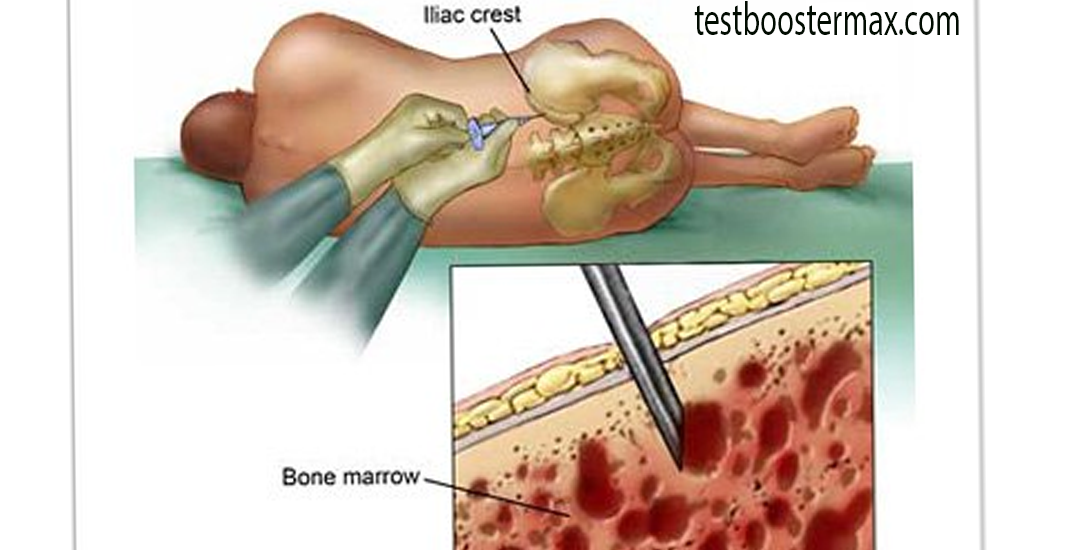 Leukemia Ketika Sumsum Tulang