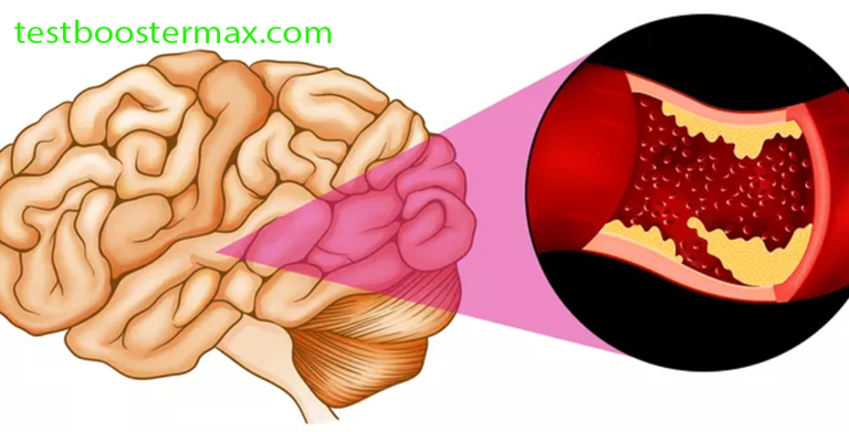 Memahami Stroke Iskemik Trombotik: Ketika Gumpalan Darah