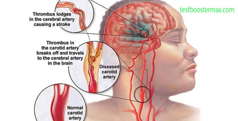 Stroke Iskemik Ketika Aliran Darah ke Otak Terhambat