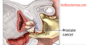 Kanker Prostat Pria Waspada