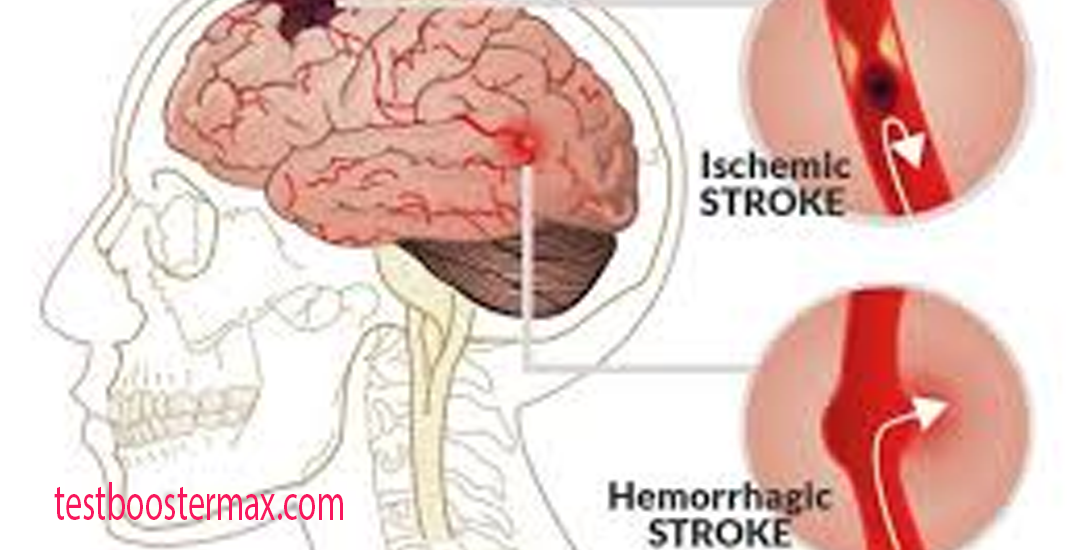 Penanganan Awal Stroke