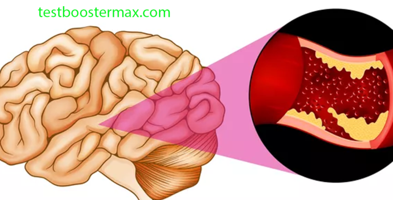 Stroke Iskemik Memahami Penyebab Gejala Diagnosis