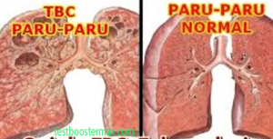 Tuberkulosis Ekstra Paru