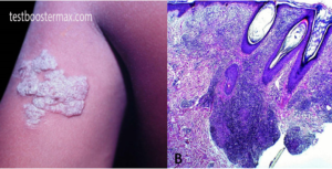 Tuberkulosis Verrucosa Cutis