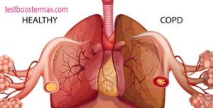 COPD Penyakit Paru