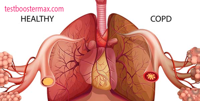 COPD Penyakit Paru Obstruktif Kronik