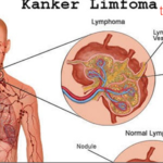 Gejala Leukemia Pembengkakan Kelenjar Getah Bening