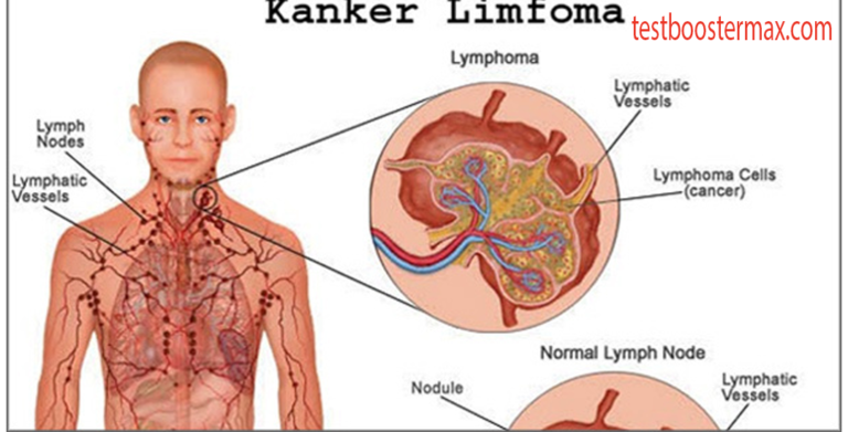 Gejala Leukemia Pembengkakan Kelenjar Getah Bening