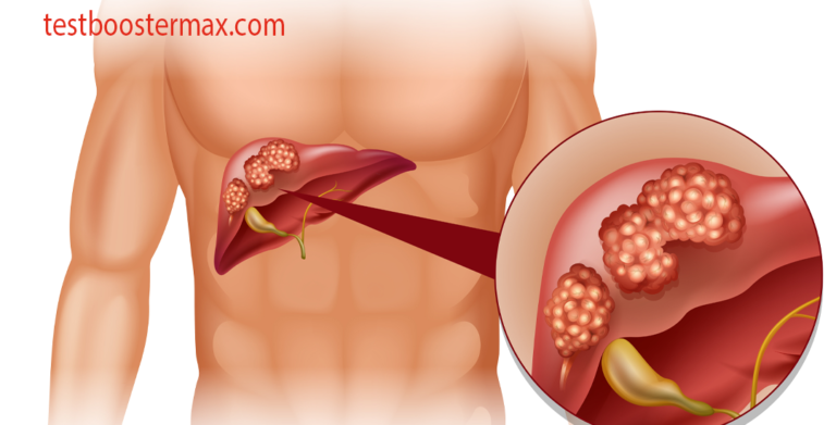 Kanker Hati Pemahaman Gejala dan Pengobatan