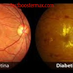 Penyakit Mata Akibat Diabetes: Retinopati Diabetik dan Ancaman