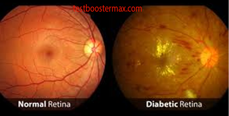 Penyakit Mata Akibat Diabetes: Retinopati Diabetik dan Ancaman