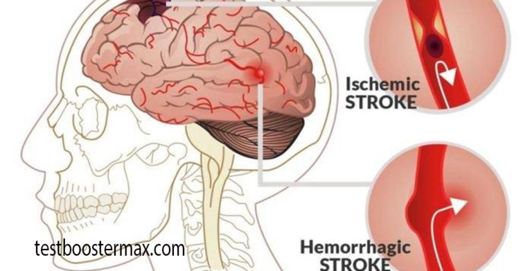 Stroke Hemoragik Memahami Perdarahan Di Dalam Otak