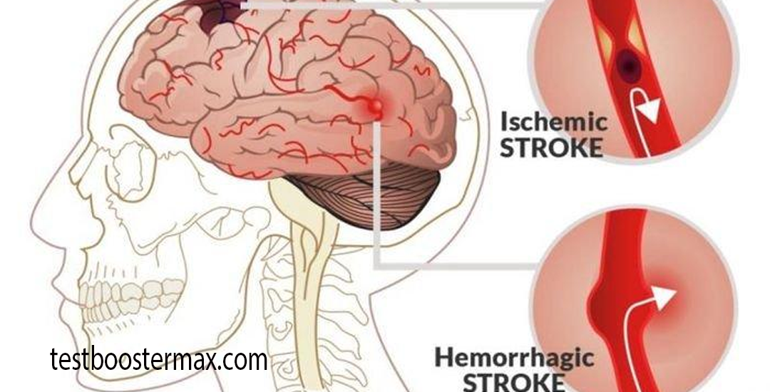 Stroke Hemoragik Memahami Perdarahan