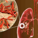 Tuberkulosis Penyakit Menular yang Dapat Dicegah dan Diobati