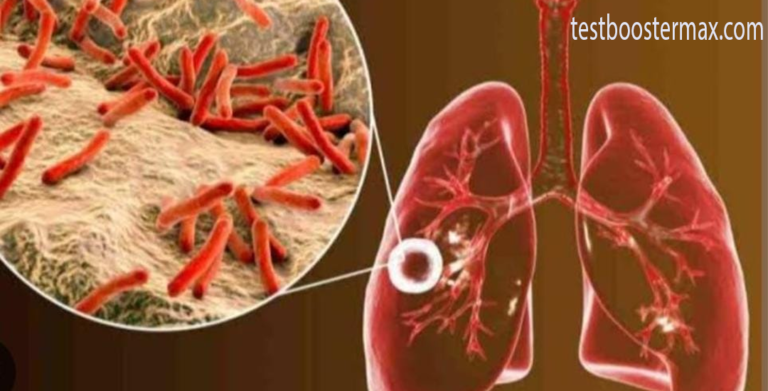 Tuberkulosis Penyakit Menular yang Dapat Dicegah dan Diobati