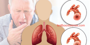 COPD