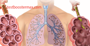 Emfisema
