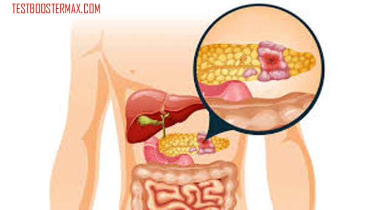 Mengenal Lebih Dekat Kanker Pankreas: Penyakit Mematikan