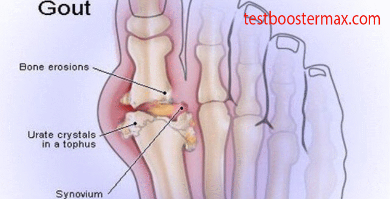 Serangan Gout Kondisi Paling Umum Akibat Timbunan Asam Urat
