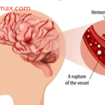 Stroke Penyebab Utama Kematian dan Kecacatan di Dunia