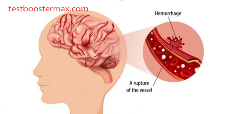 Stroke Penyebab Utama Kematian dan Kecacatan di Dunia