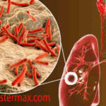Tuberkulosis (TBC) Infeksi Paru-paru yang Perlu Diketahui