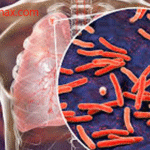 Tuberkulosis Paru (TB Paru): Infeksi Bakteri MTB dan Gejalanya