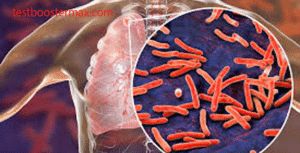 Tuberkulosis Paru (TB Paru): Infeksi Bakteri MTB dan Gejalanya