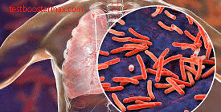 Tuberkulosis Paru (TB Paru): Infeksi Bakteri MTB dan Gejalanya