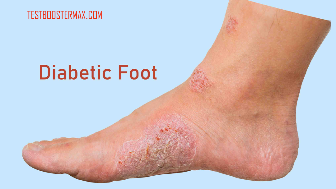 Diabetic Foot