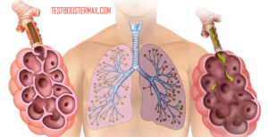 Emfisema