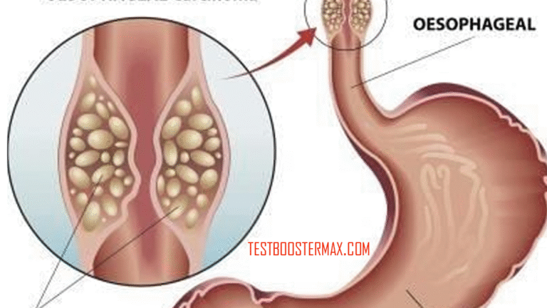 Kanker Esofagus: Penyakit Mematikan dengan Tingkat