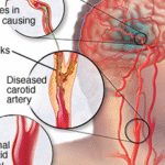 Kenali Gejala dan Resiko Stroke: Pentingnya Kesadaran