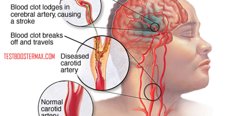 Kenali Gejala dan Resiko Stroke: Pentingnya Kesadaran