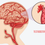 Stroke Hemorrhagic: Ketika Pembuluh Darah di Otak Pecah