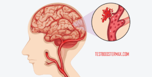 Stroke Hemorrhagic