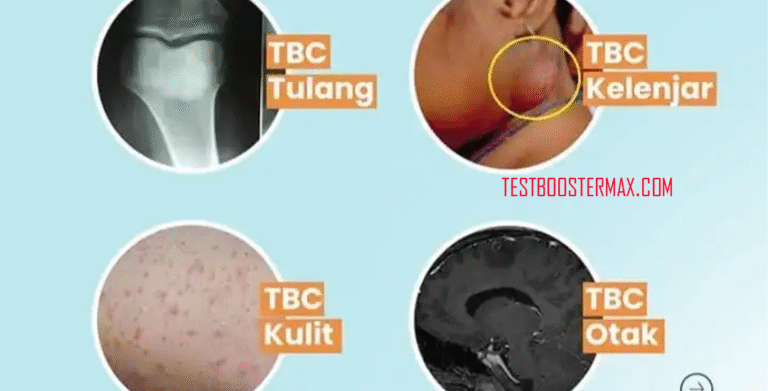 4 Macam Penyakit Tuberkulosis yang Perlu Kamu Ketahui