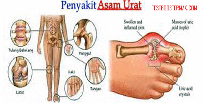 8 Tips Cegah Serangan Asam Urat