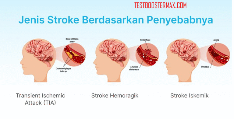 Stroke Berdasarkan Penyebabnya: Pemahaman Mendalam