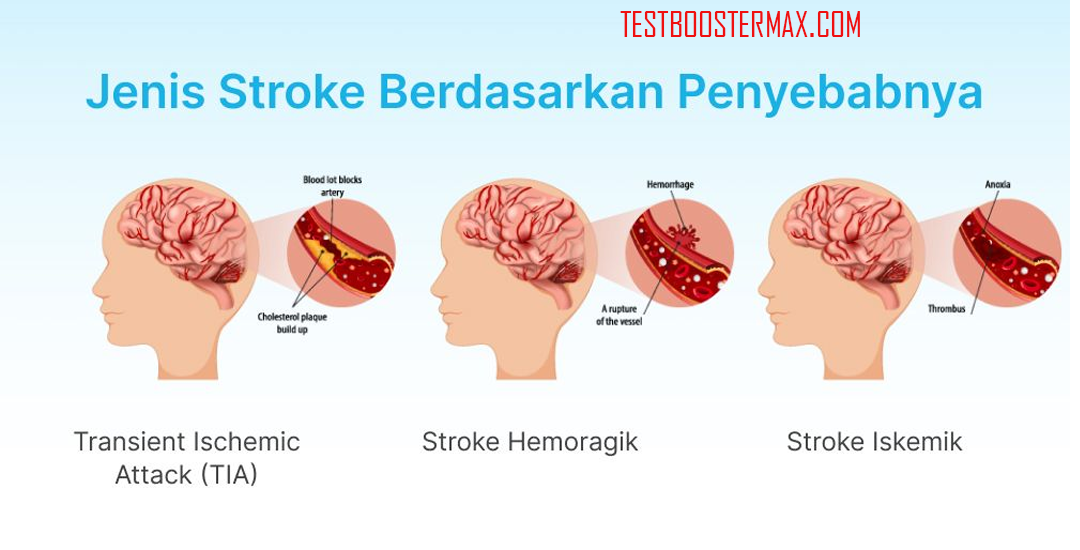 Stroke